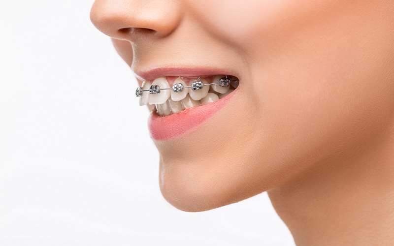 Ortodonti Tedavisi Nedir? Gülüşünüzü Düzeltmek İçin Adım Adım Rehberimiz