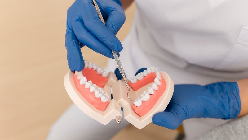 Kancalı Diş Protezleri